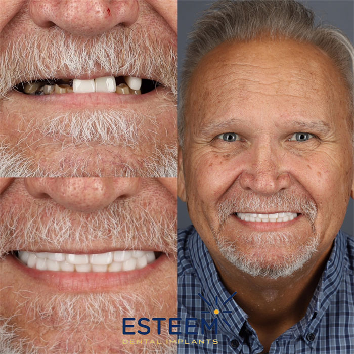 esteem before and after case
